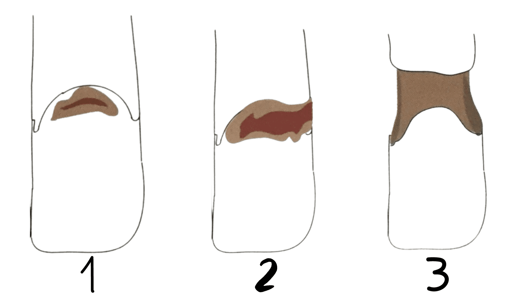 Gumline tooth decay: the three stages