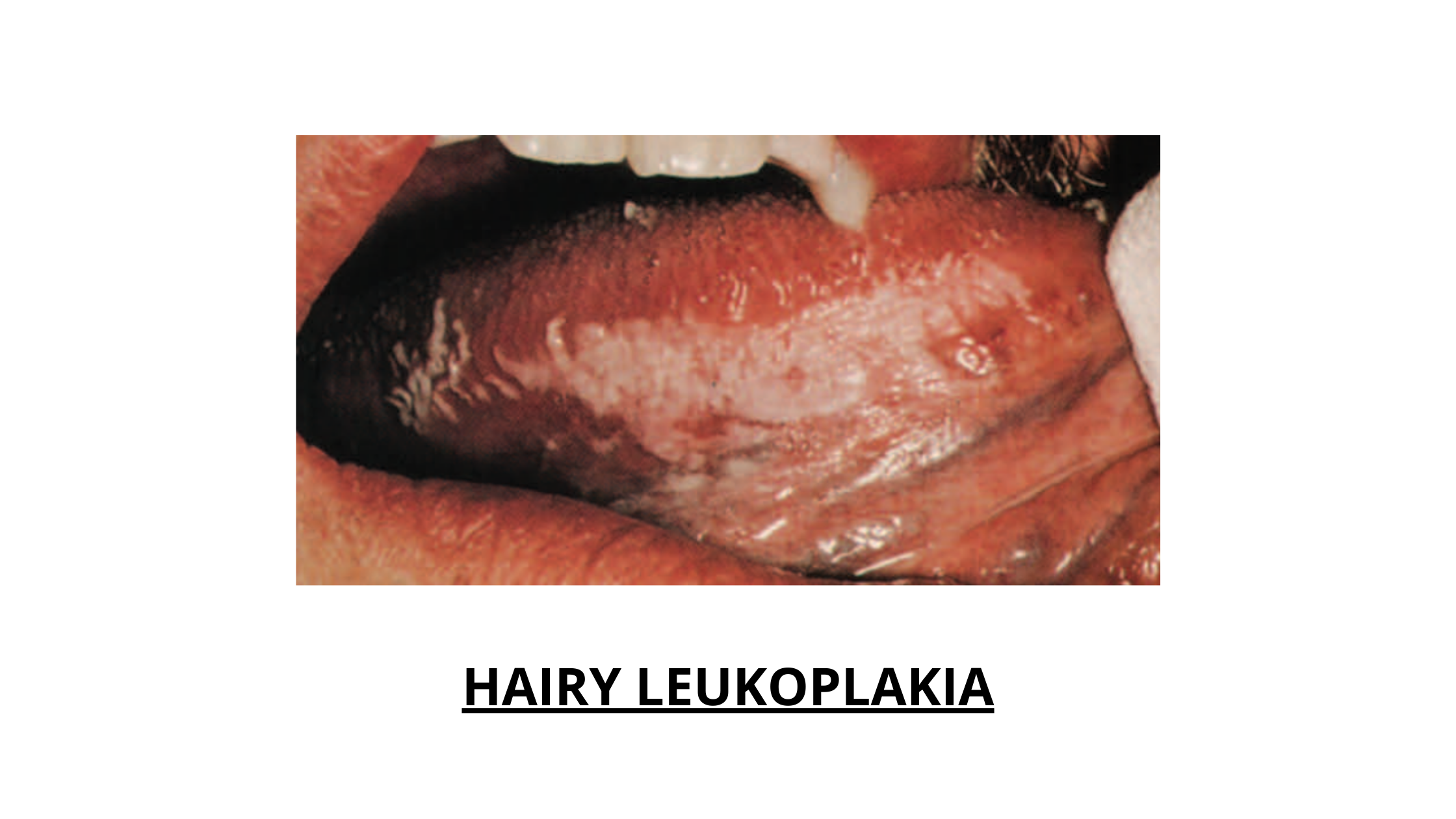 HIV-related hairy leukoplakia