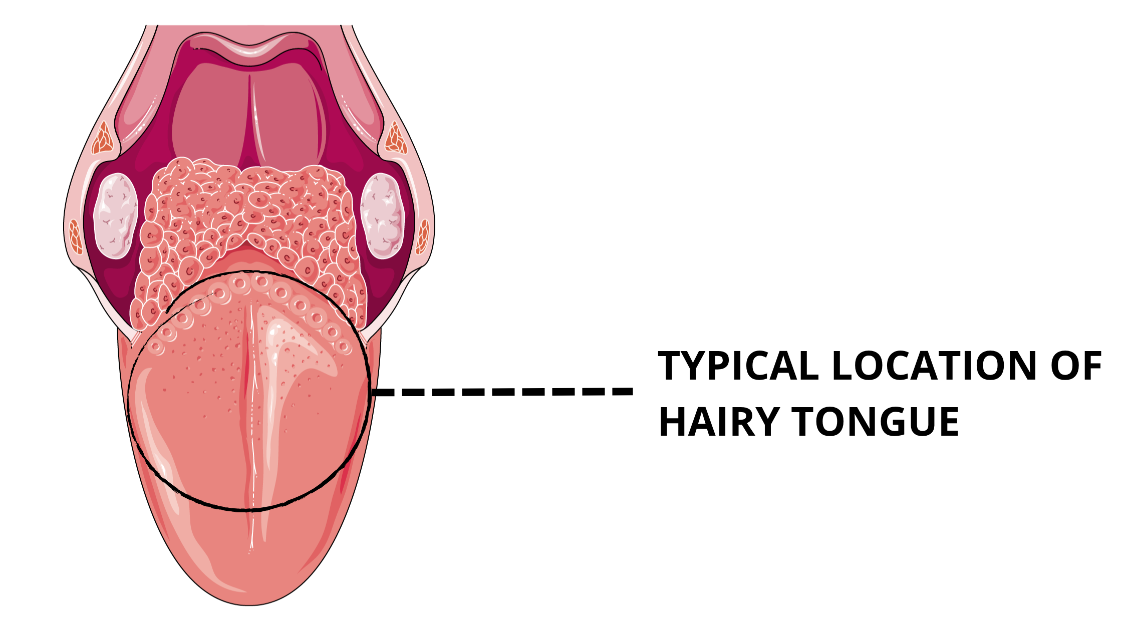 The typical site of hairy tongue