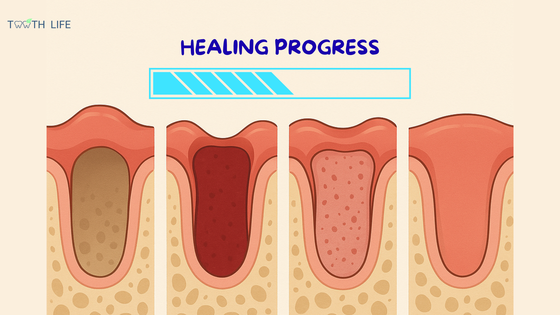 Image showing the 4 healing stages after a tooth extraction