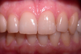 Picture of healthy gums