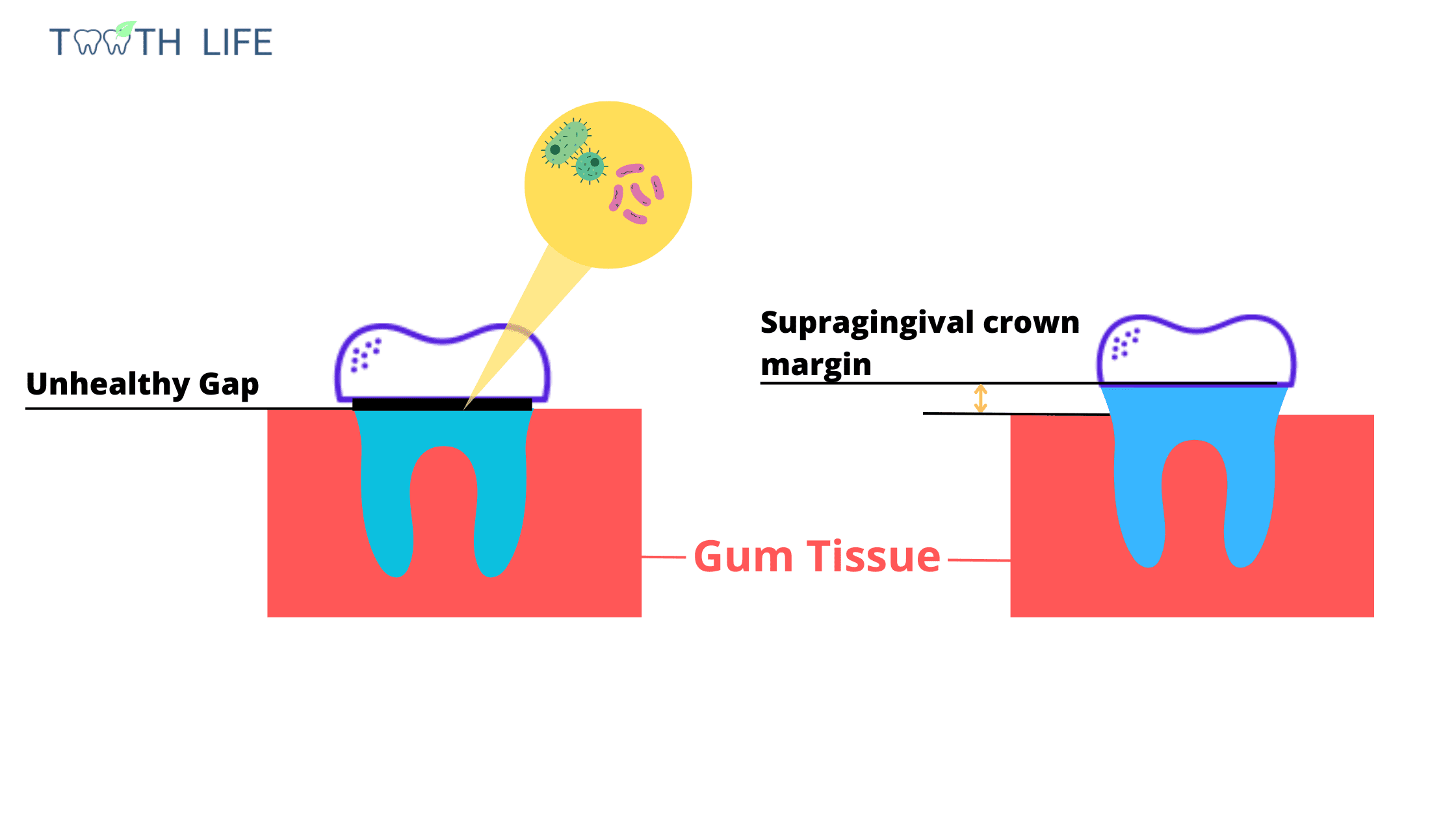 Normal vs. Abnormal gap between crown and gum
