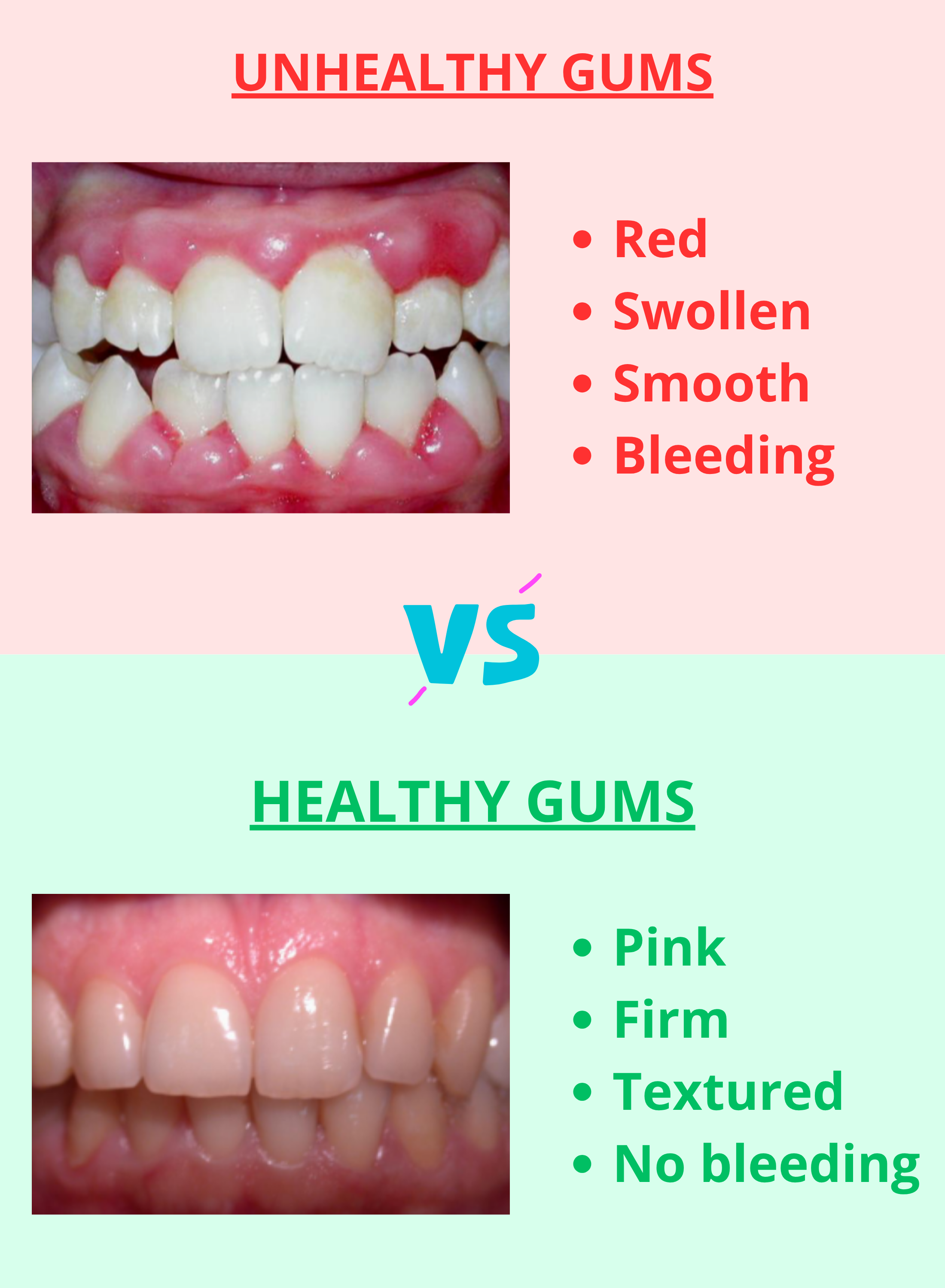Healthy vs unhealthy gums