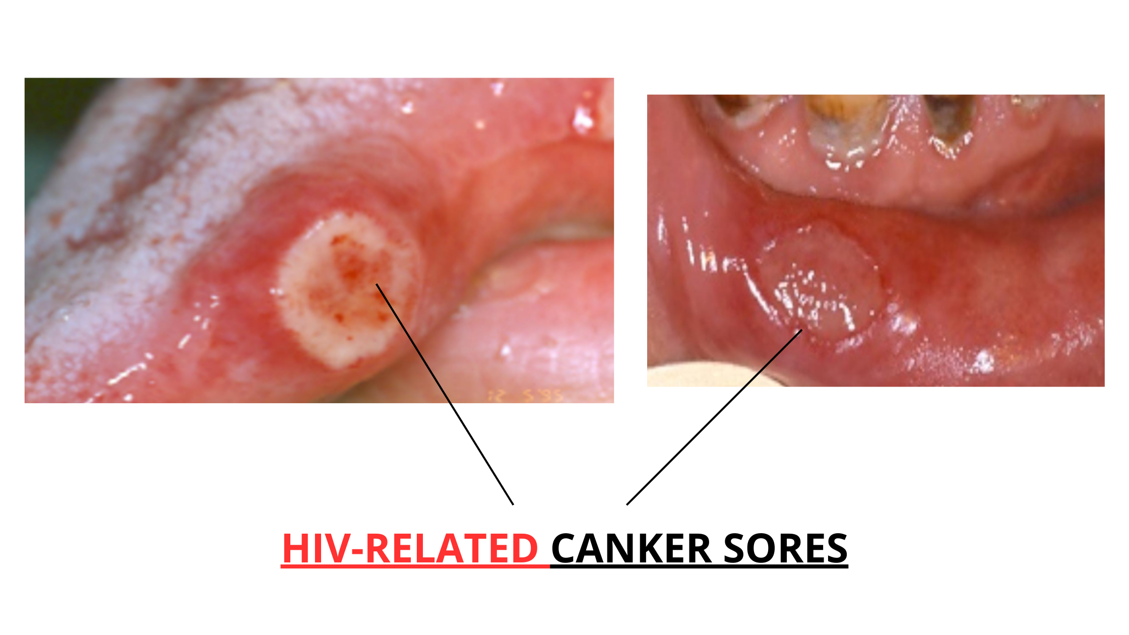 HIV-related canker sores