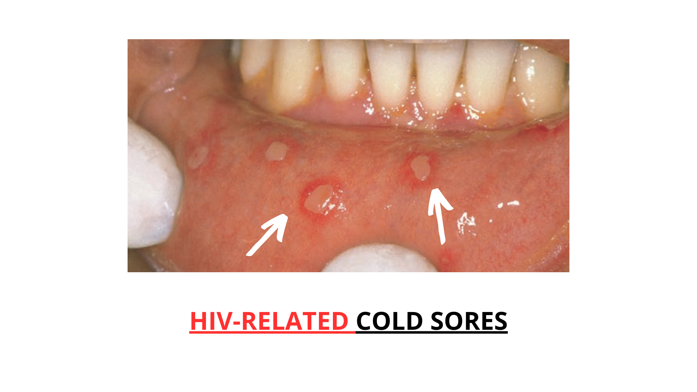 HIV Mouth Sores A Complete Visual Guide With Pictures