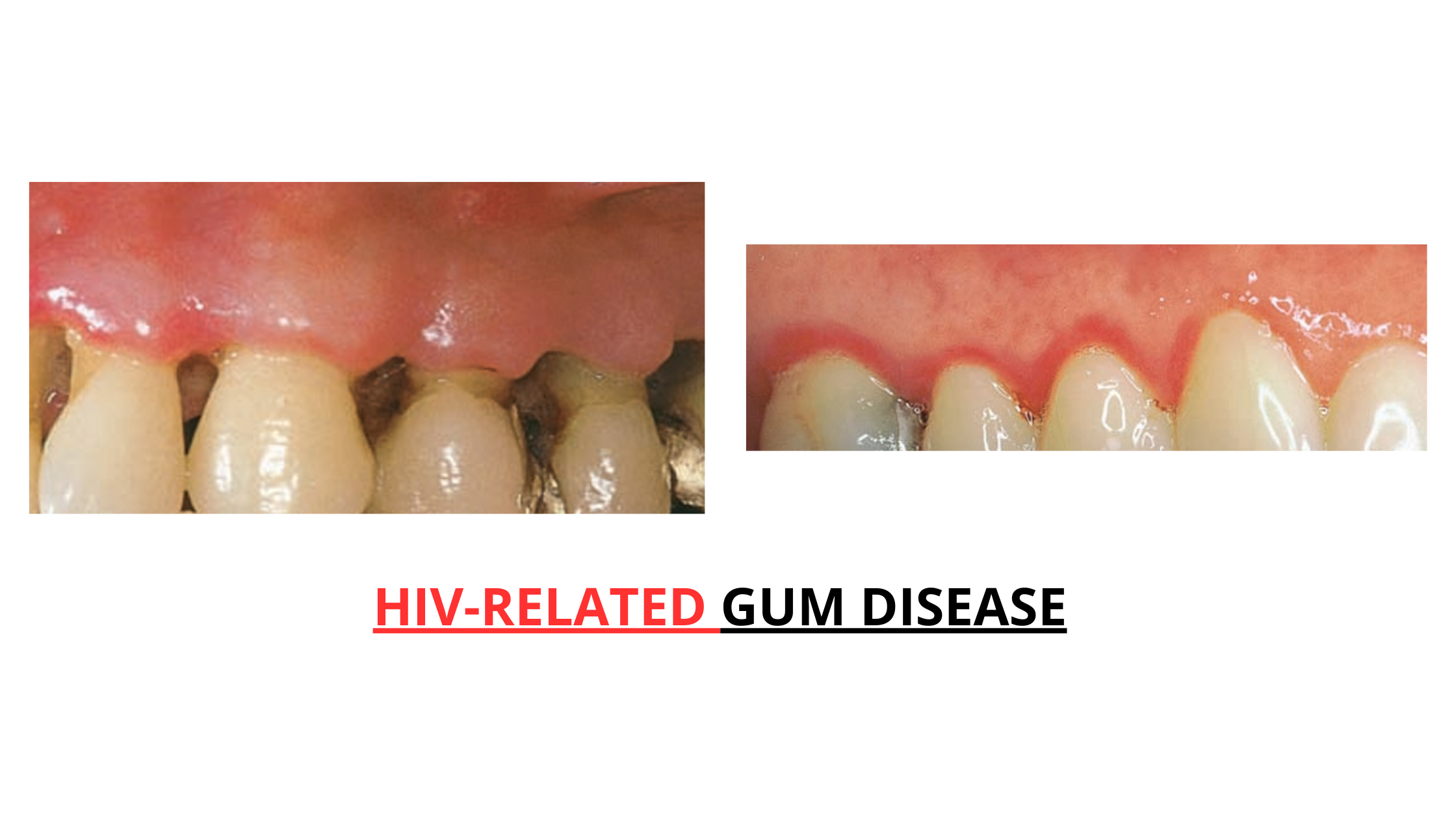 HIV-related gum disease: linear gingival erythema and necrotizing ulcerative periodontitis