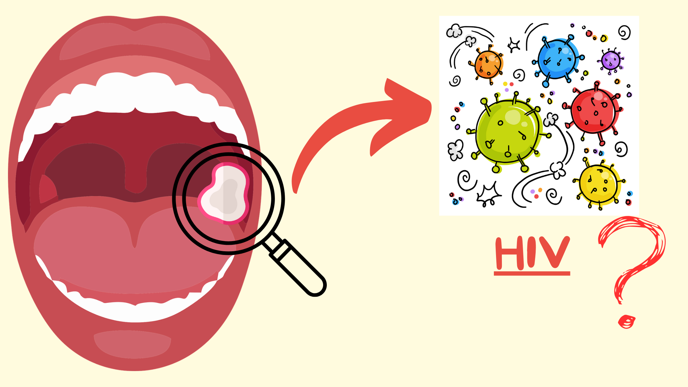 HIV-related mouth sores