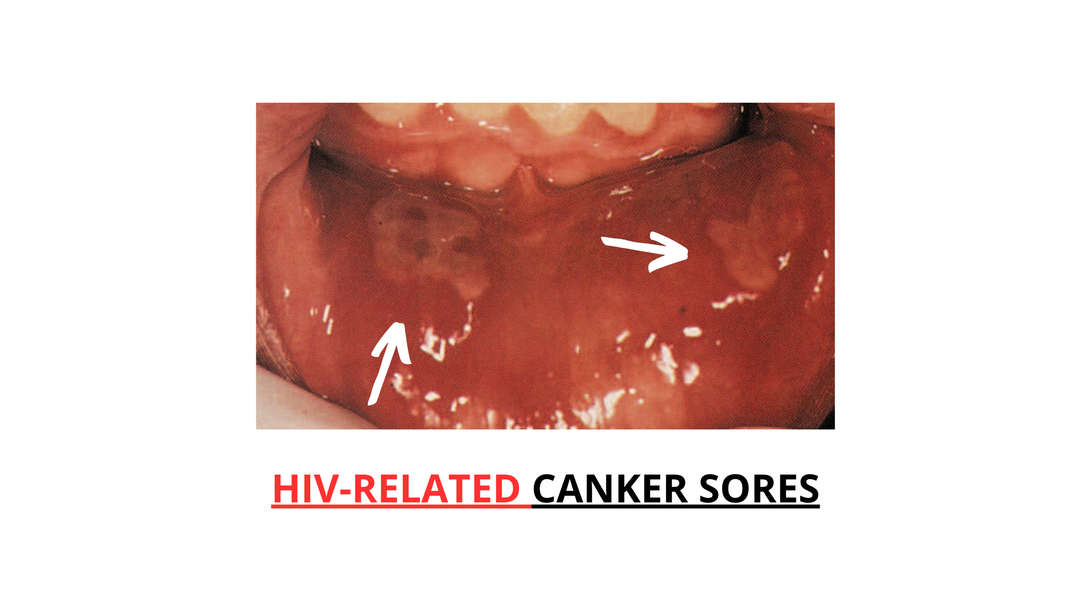 HIV-related major canker sores