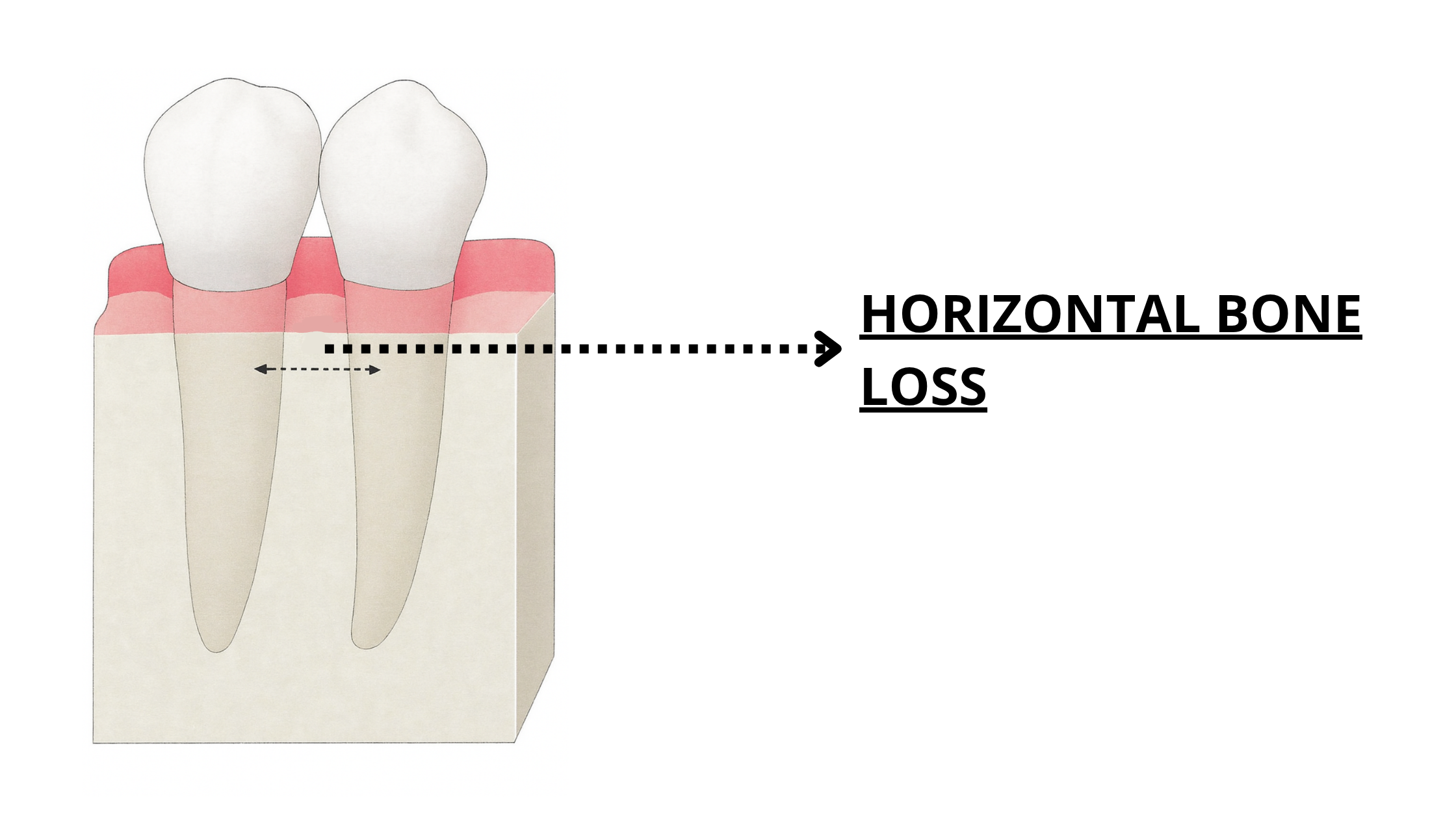 horizontal bone loss