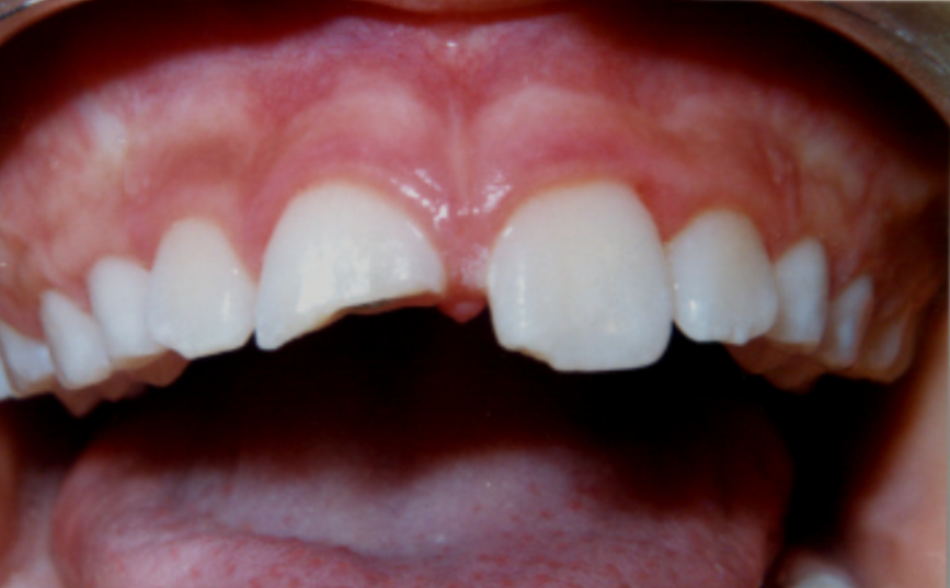 Horizontal tooth fracture due to trauma