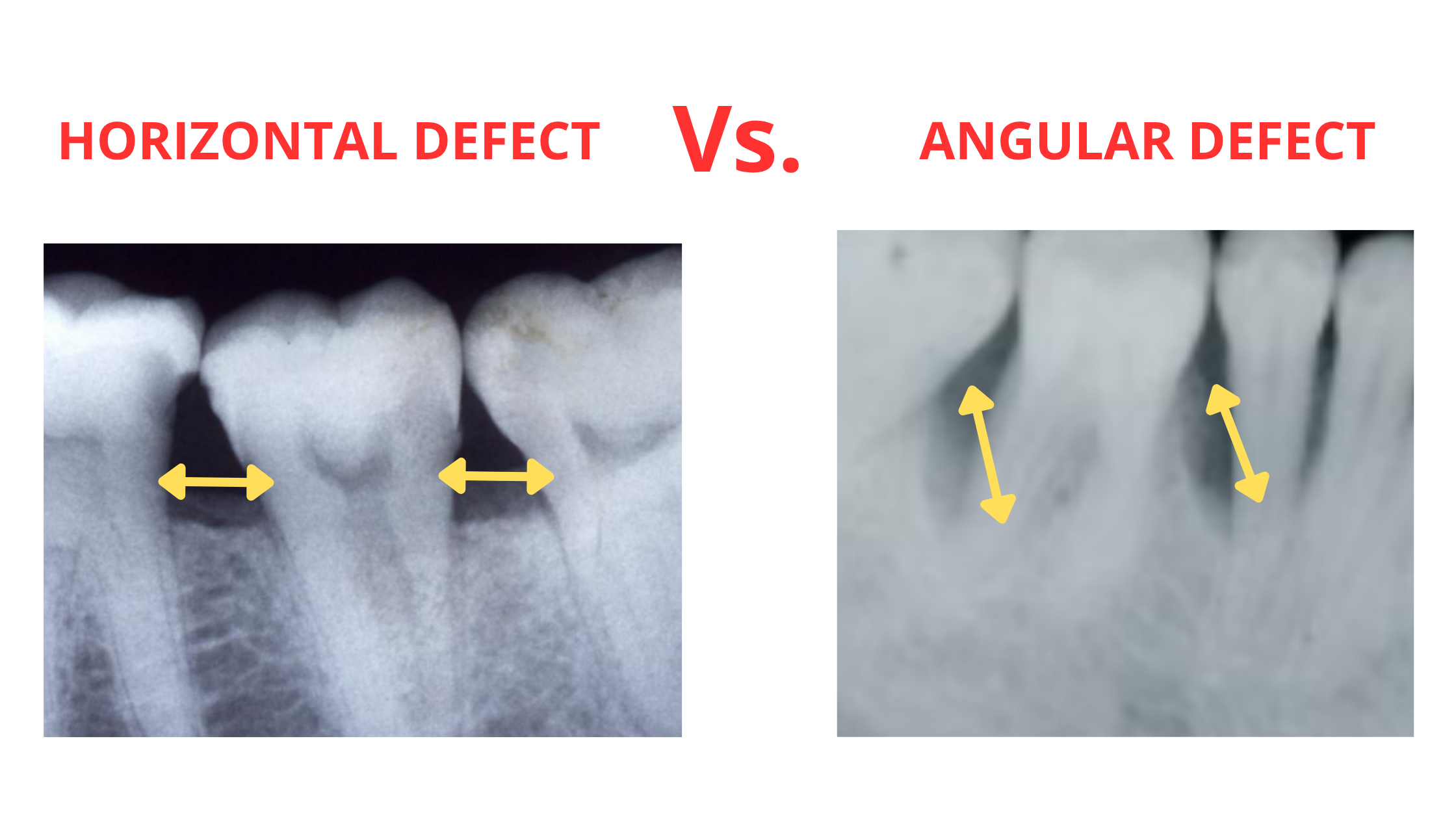 Horizontal vs angular bone loss in gum disease
