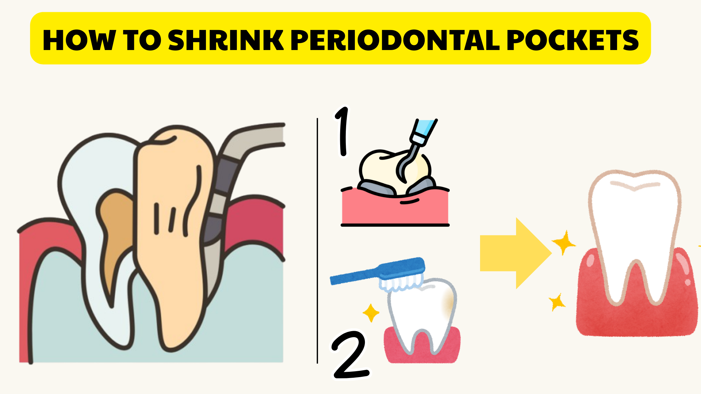 How to Heal and Shrink Gum Pockets