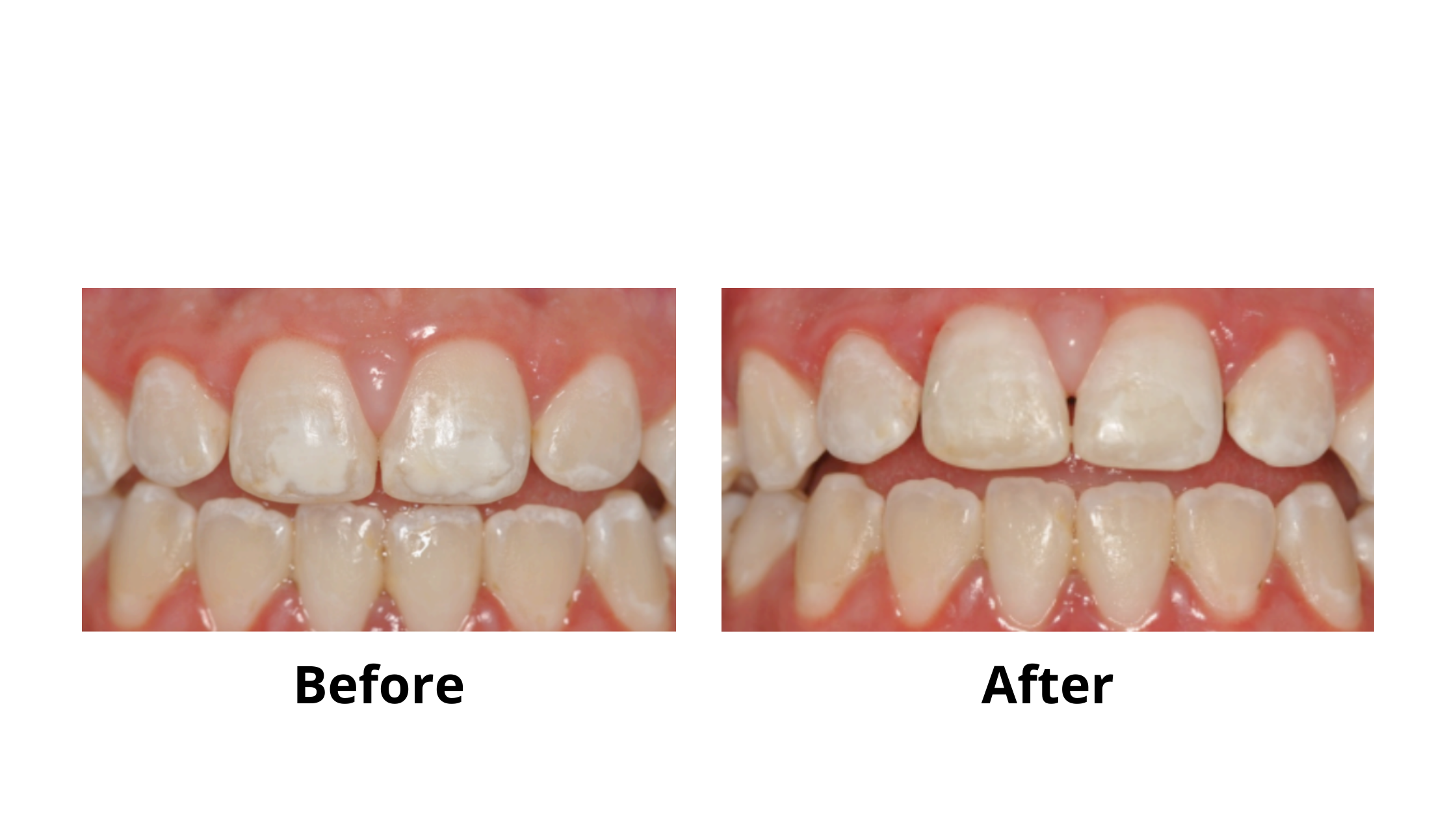 Icon resin infiltration before and after