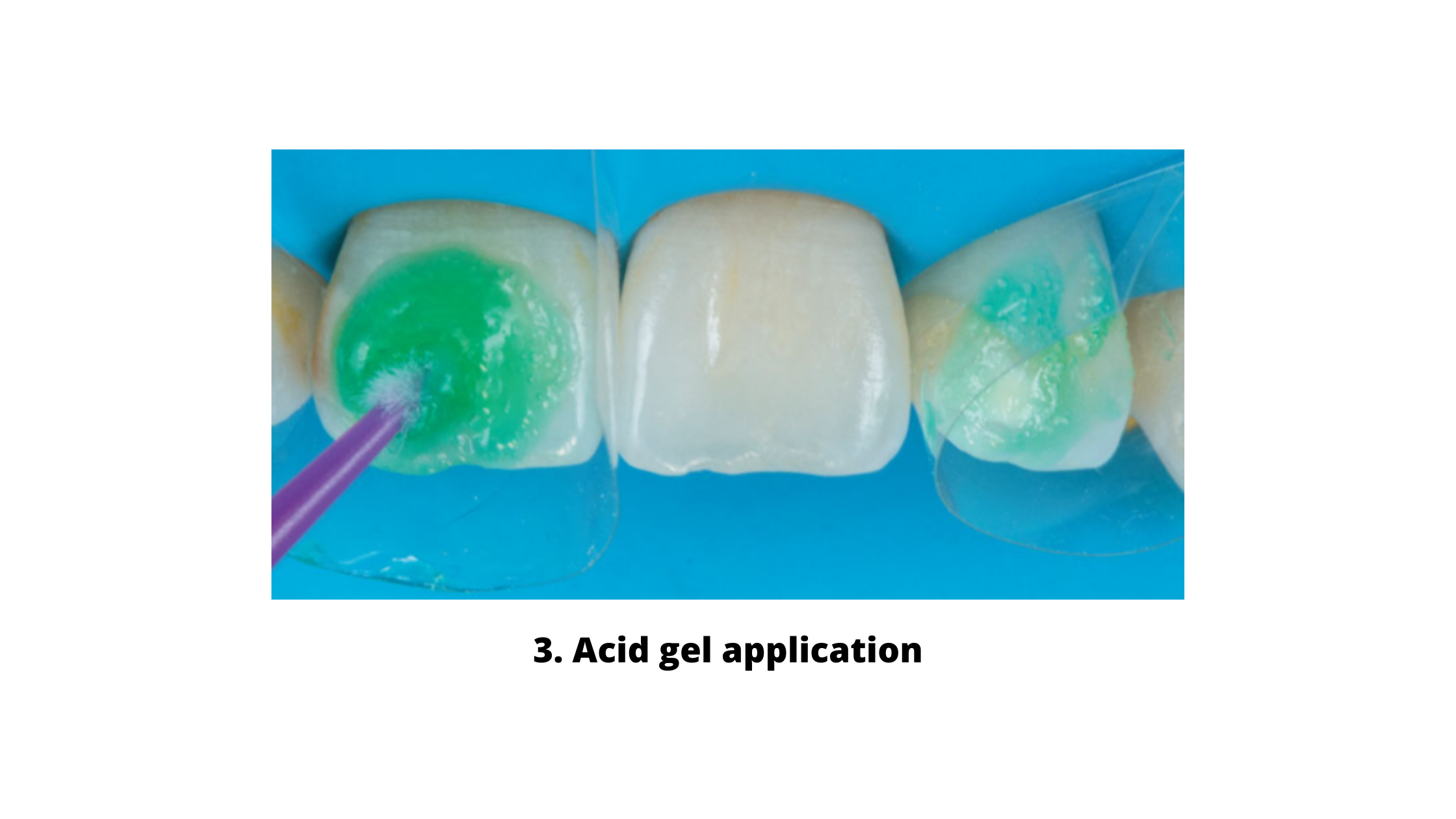acid gel application