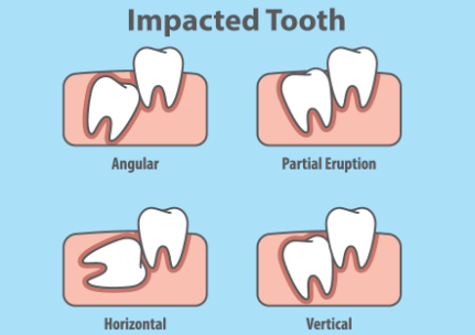 impacted wisdom teeth