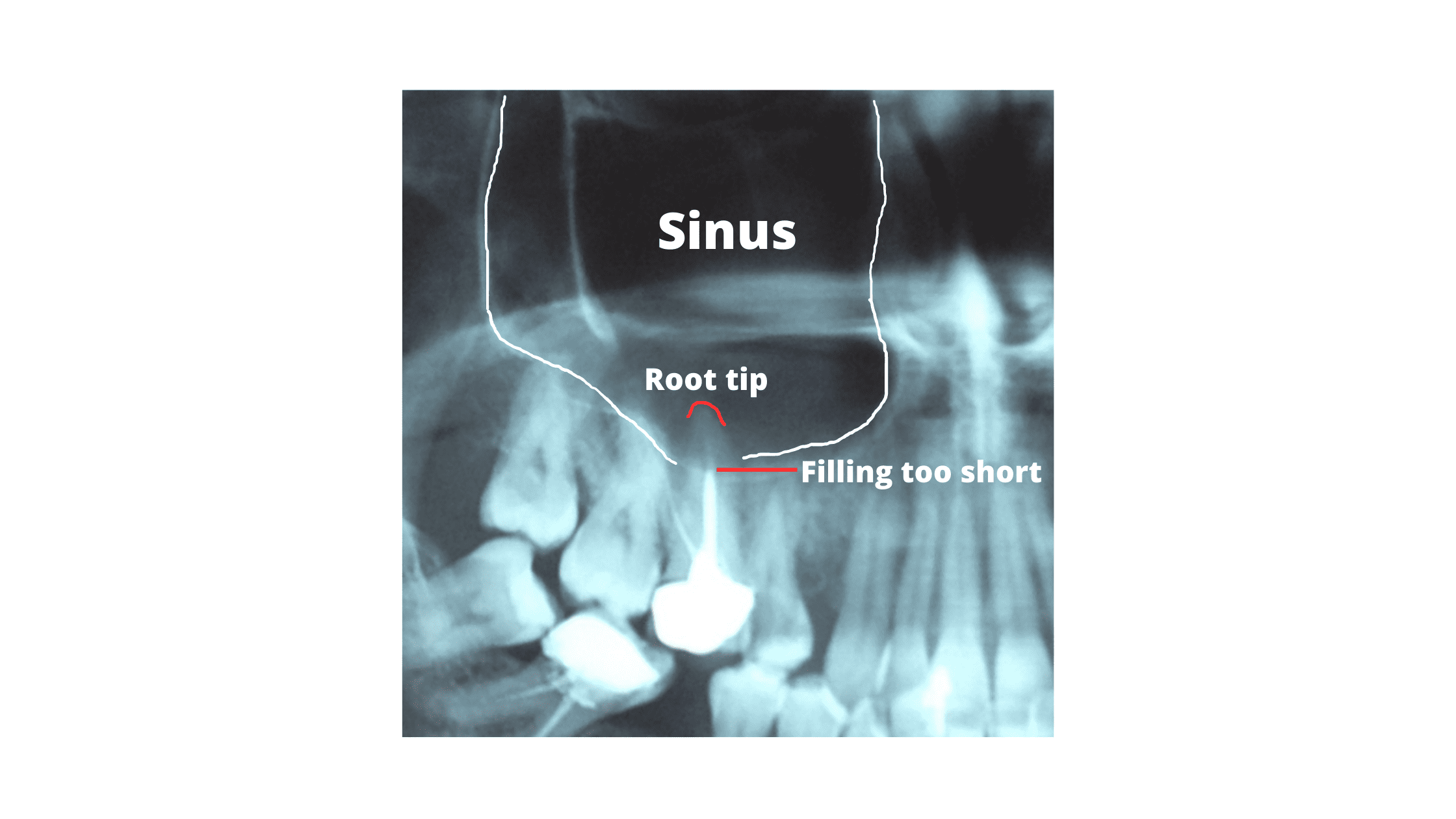 X-ray showing a short root canal filling as a cause of sinus infection