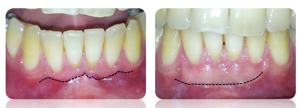 Increasing the gums height and thickness by a free gingival graft
