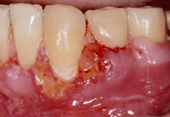Infection of the gum graft 1 week post-surgery