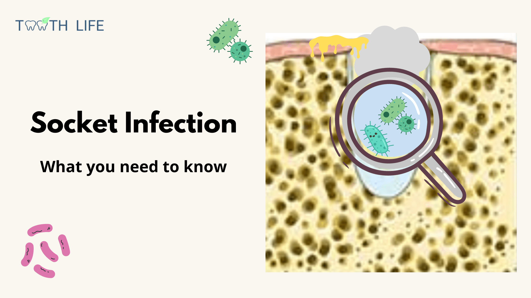 socket infection after tooth extraction