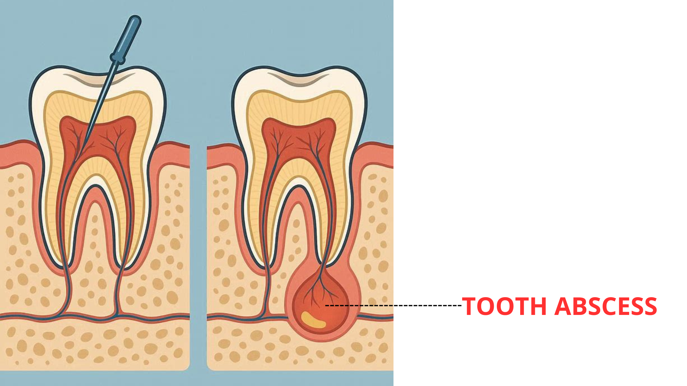 infection under root canal