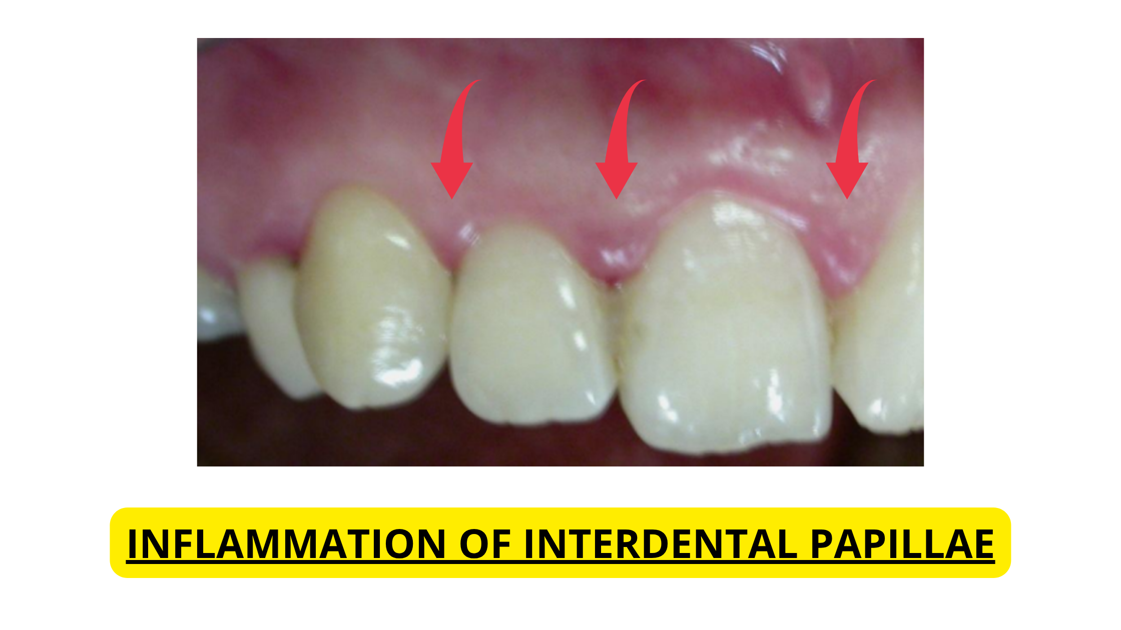 Inflammation of interdental papillae (moderate gingivitis)