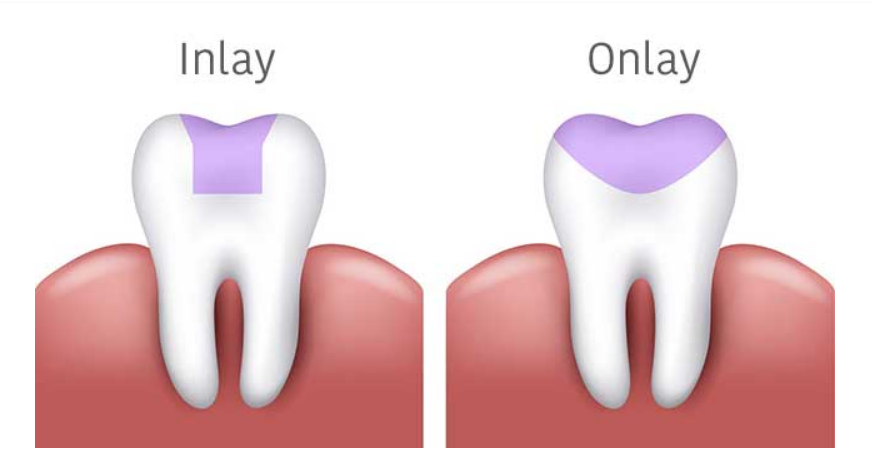 inlay and onlay