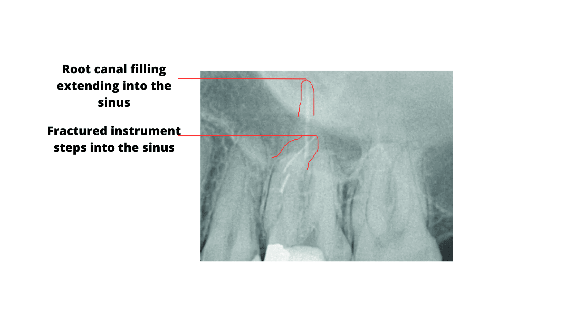 X-ray showing an instrument fracture on the root canal of an upper molar