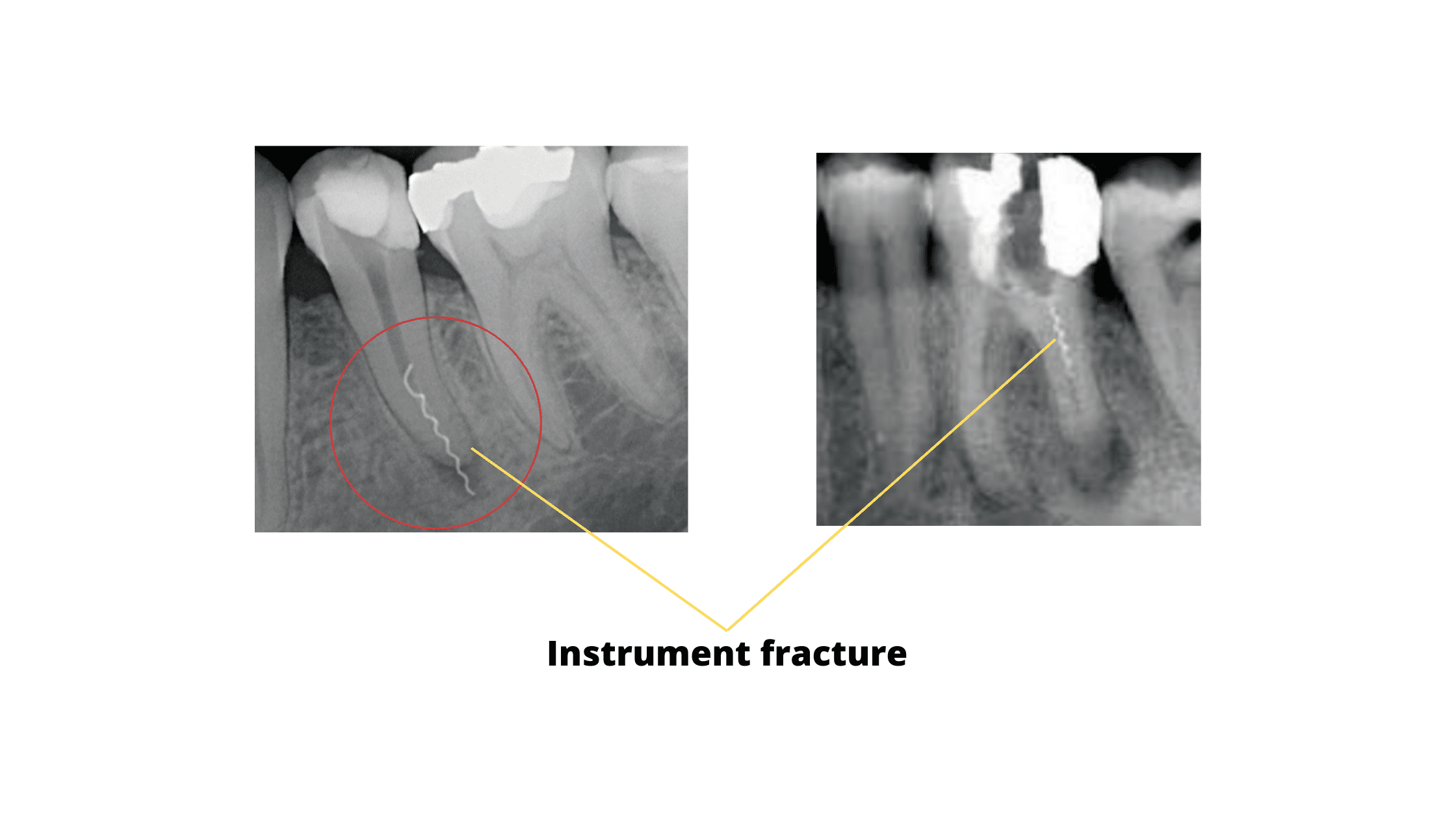 X-rays showing fractured instruments in root canals