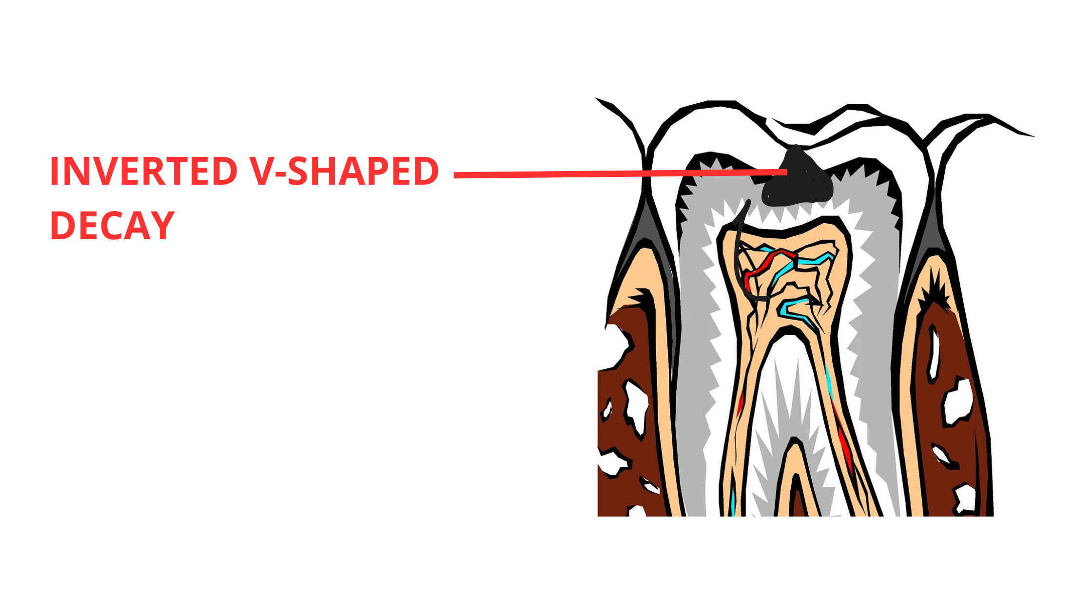 Inverted V-shaped progression of chewing surface caries