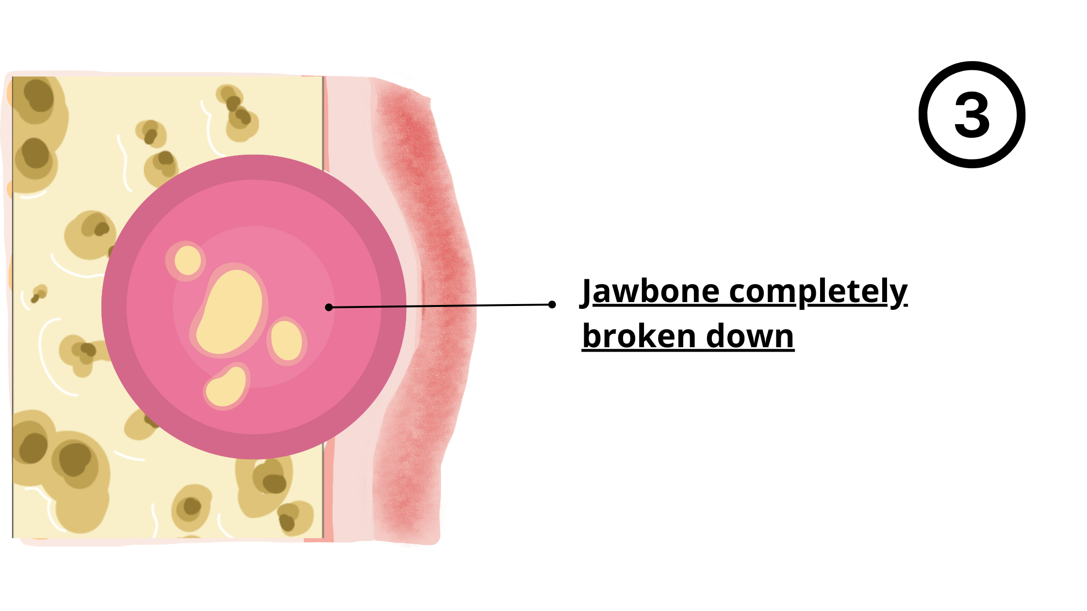 Third stage of wisdom tooth cyst