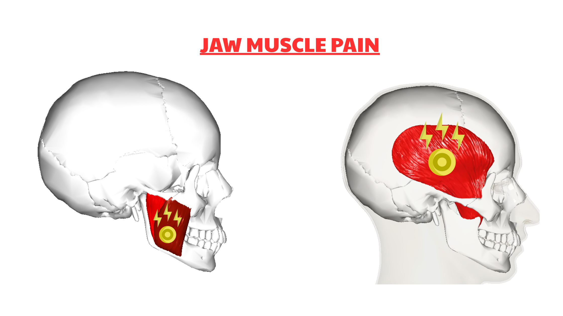 Jaw muscle pain
