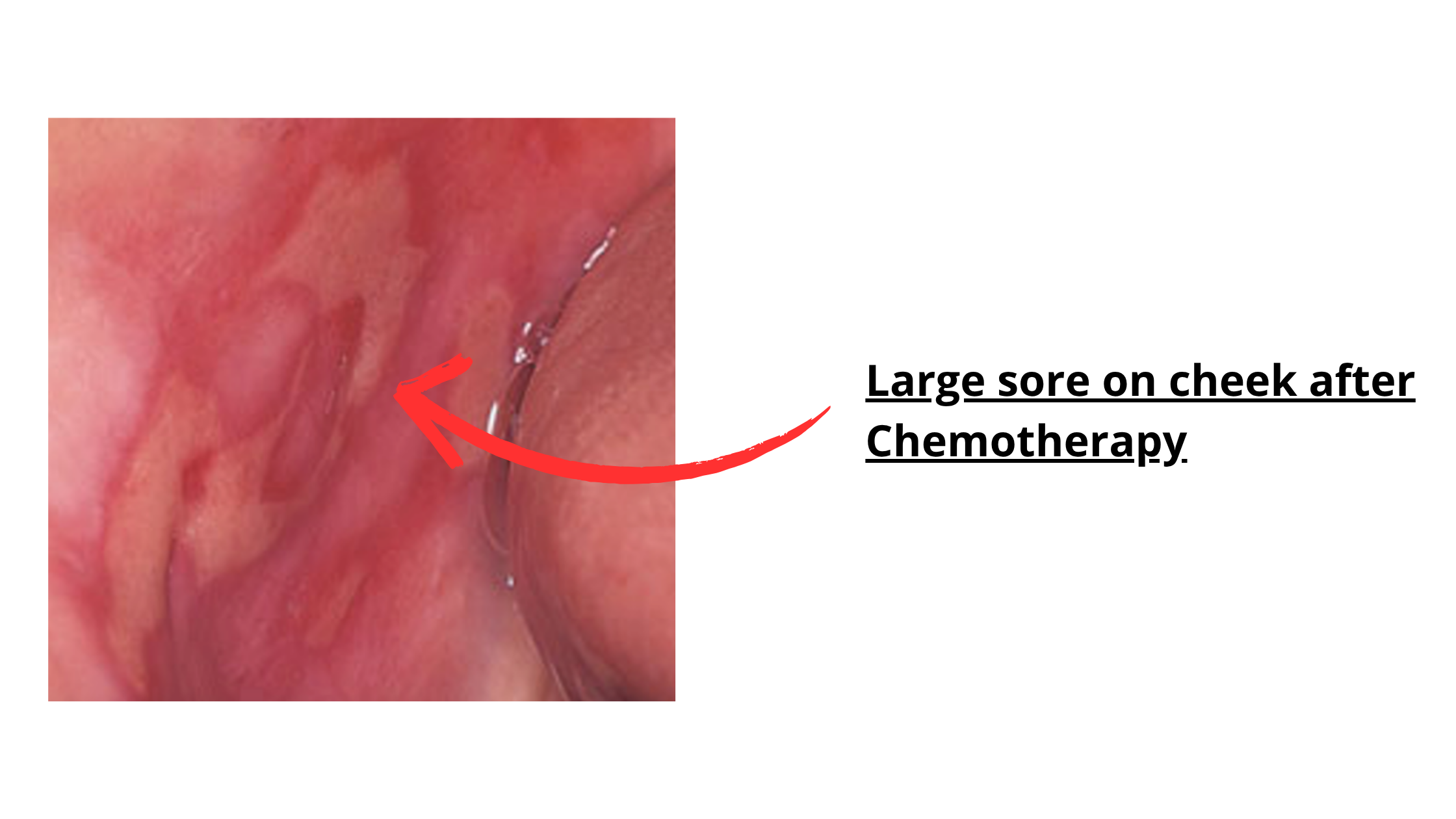 CLinical image showing a large ulcer inside the mouth after starting chemotherapy