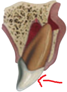 dental trauma: lateral luxation