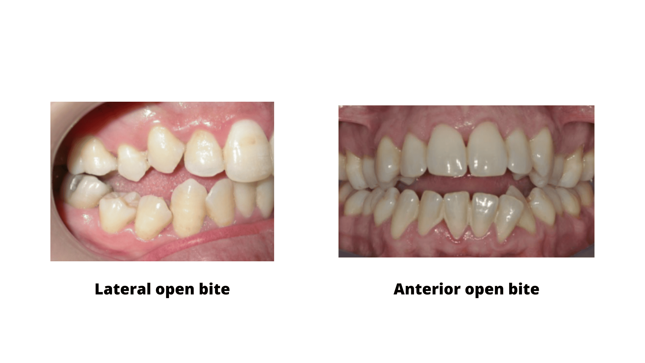 Lateral and anterior open bite