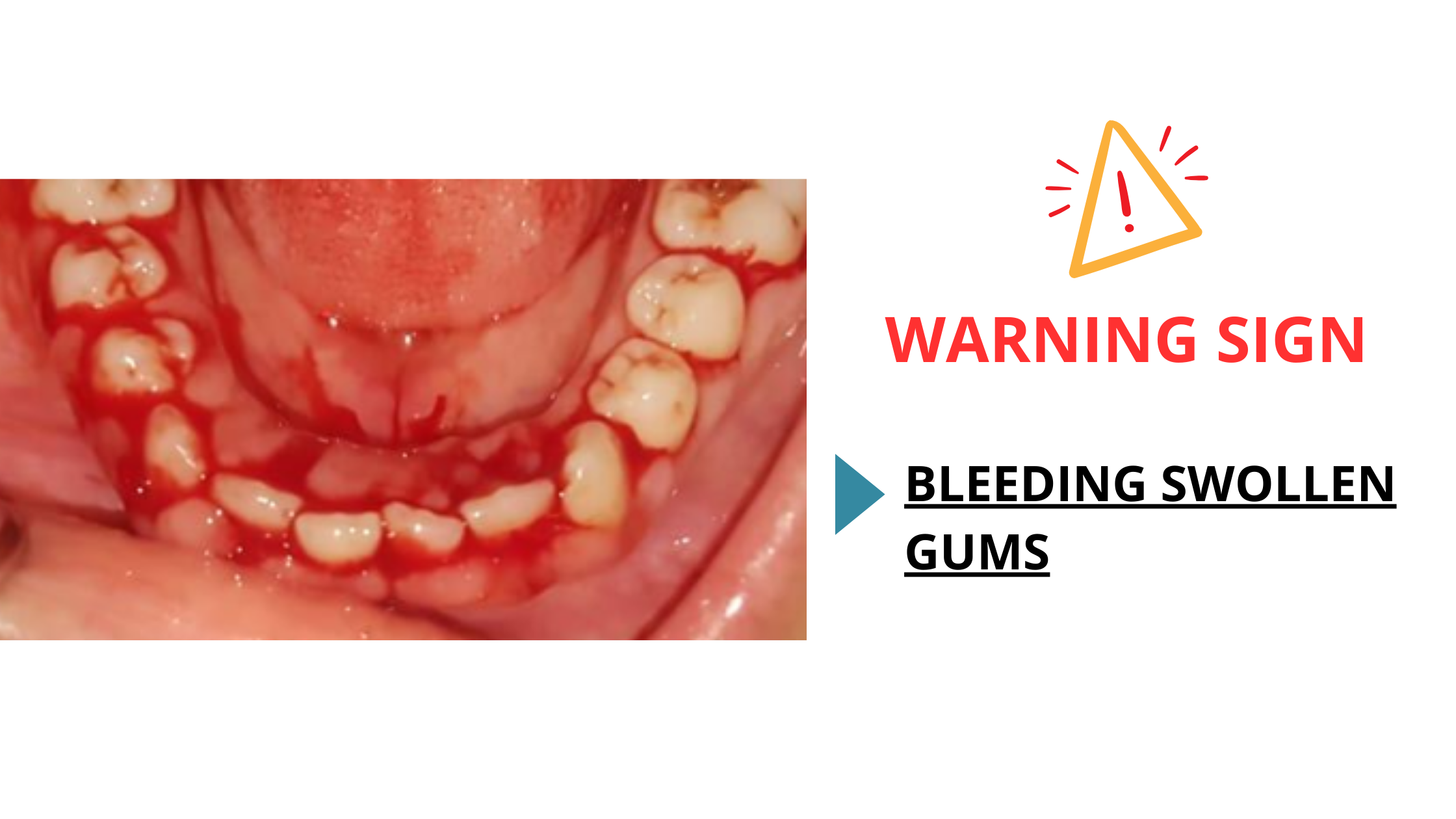 gingival hyperplasia and bleeding gums due to leukemia