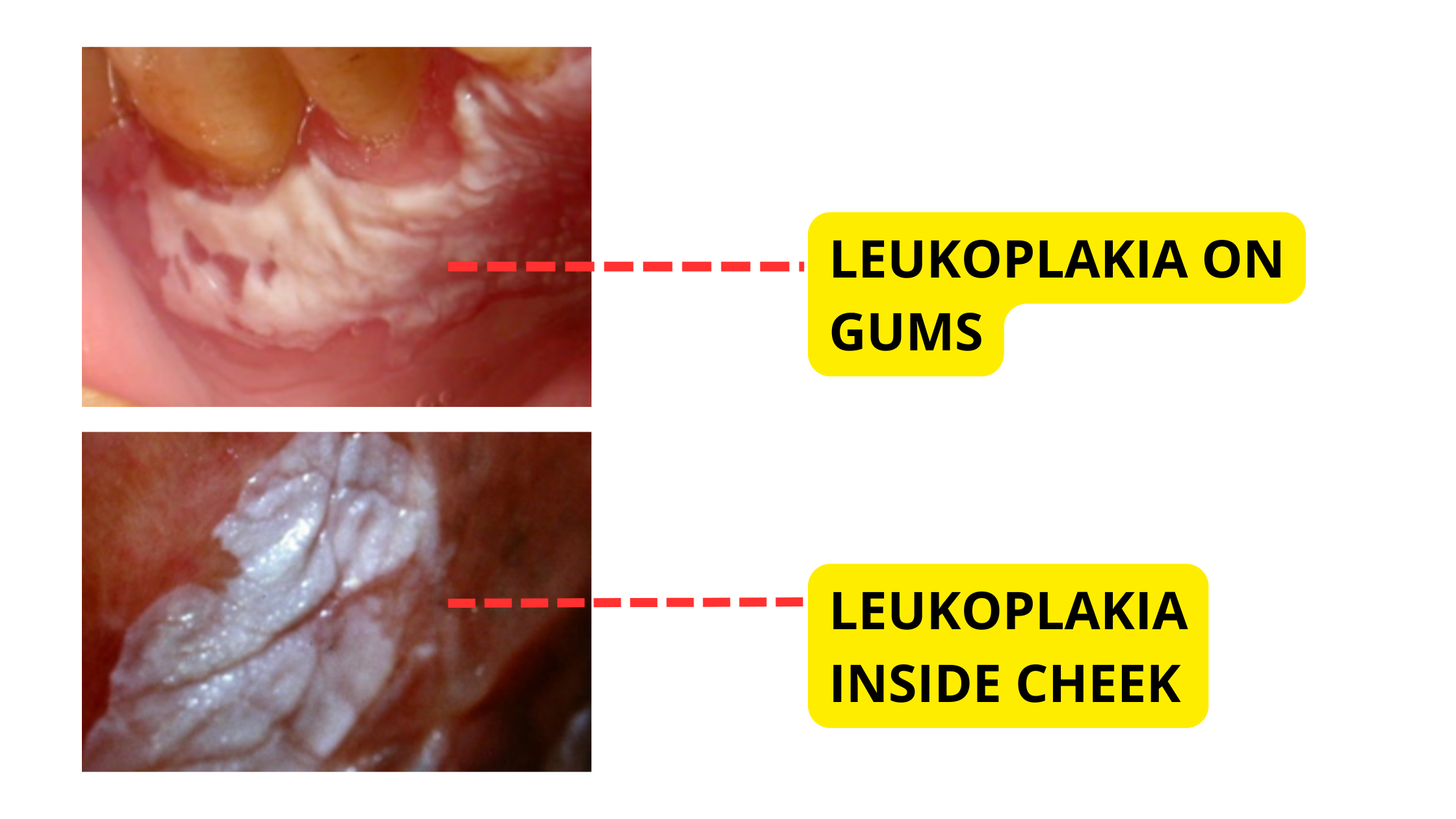 Clinical cases of leukoplakia on the gums and inside the cheeks