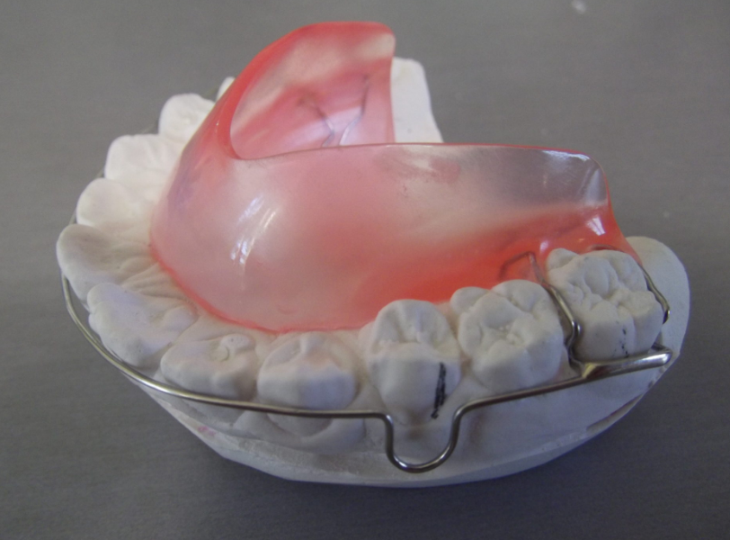 lingual night enveloppe to correct tongue posture
