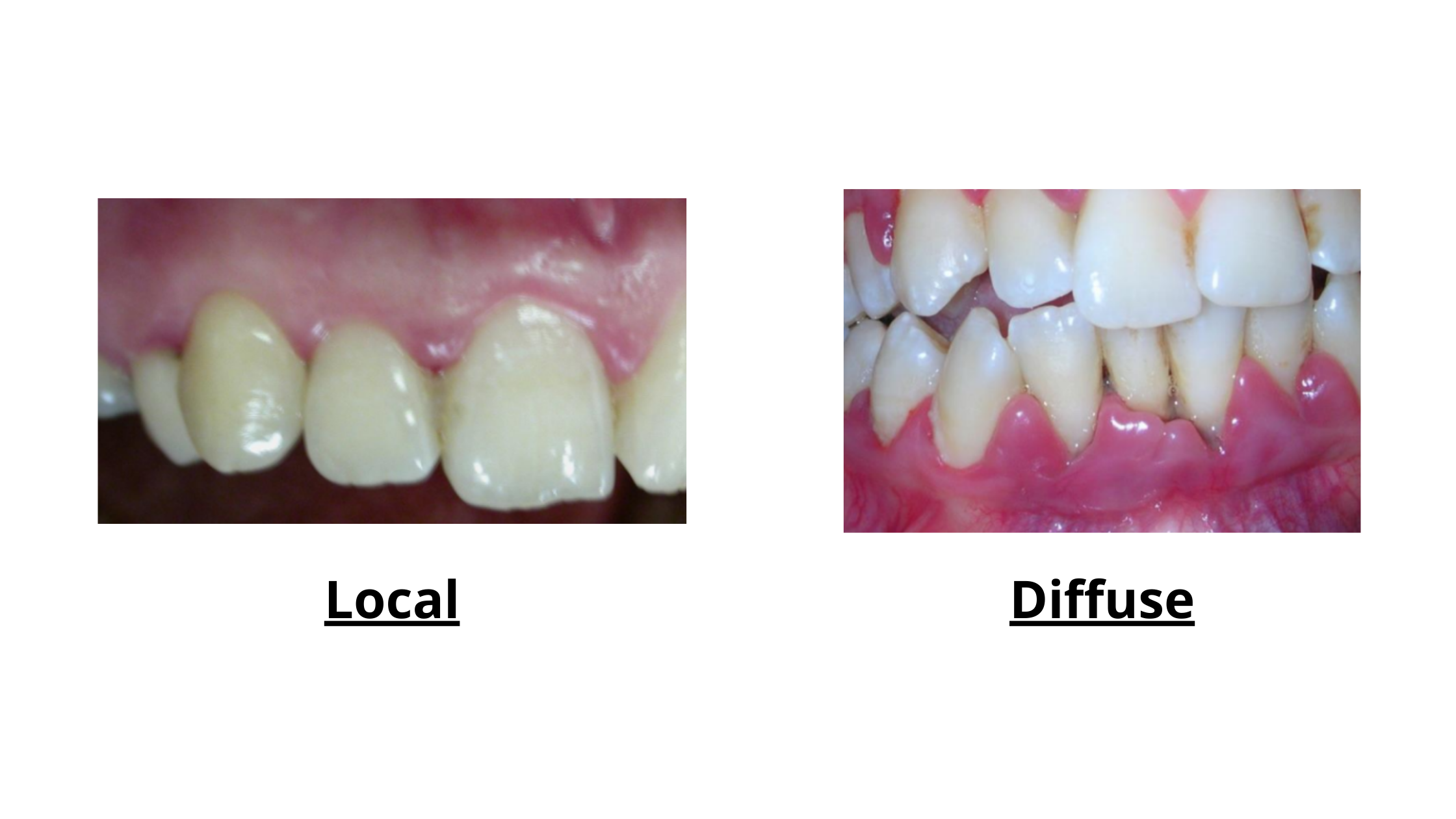 local and diffuse gingivitis