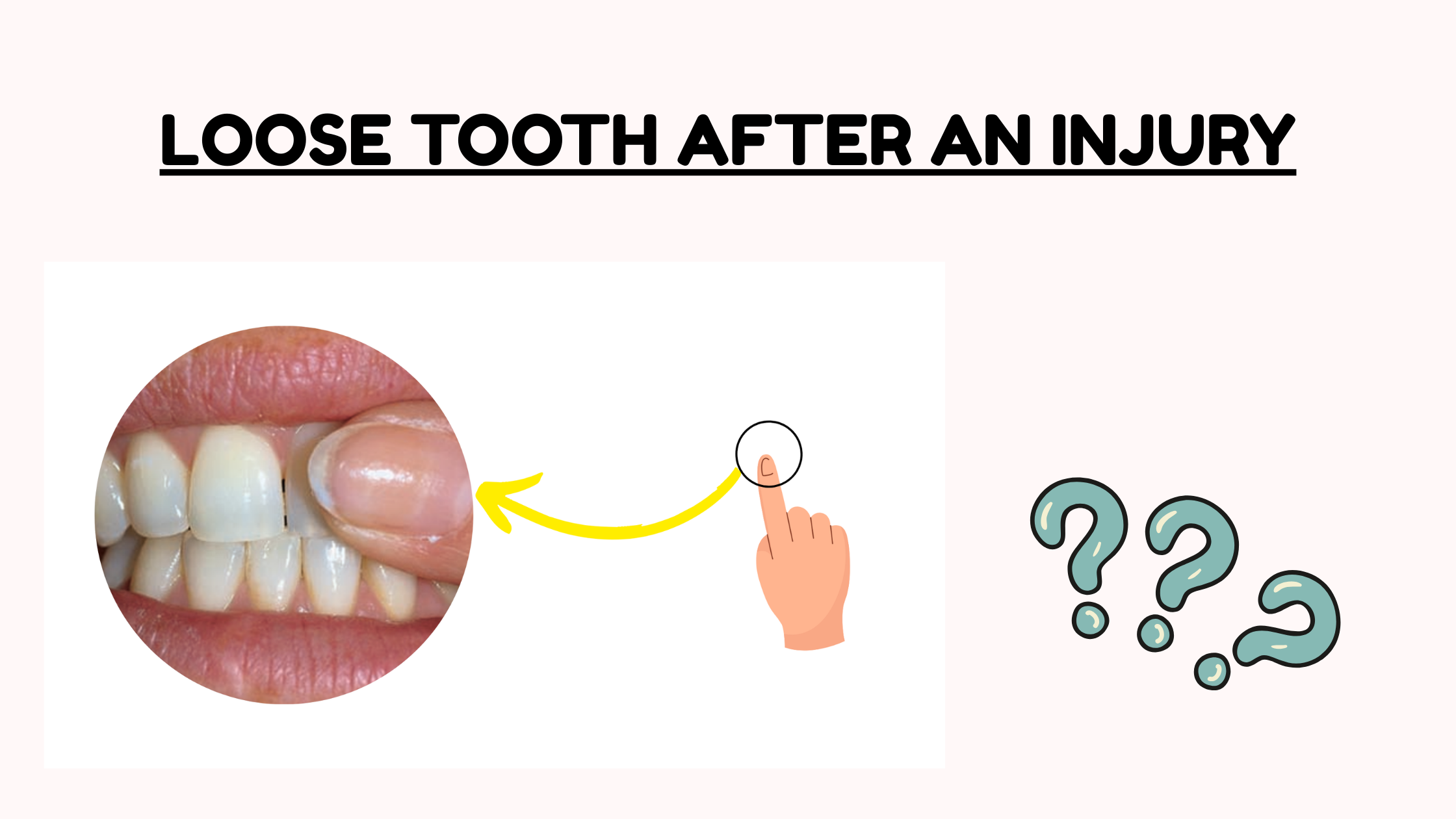 Loose tooth from injury
