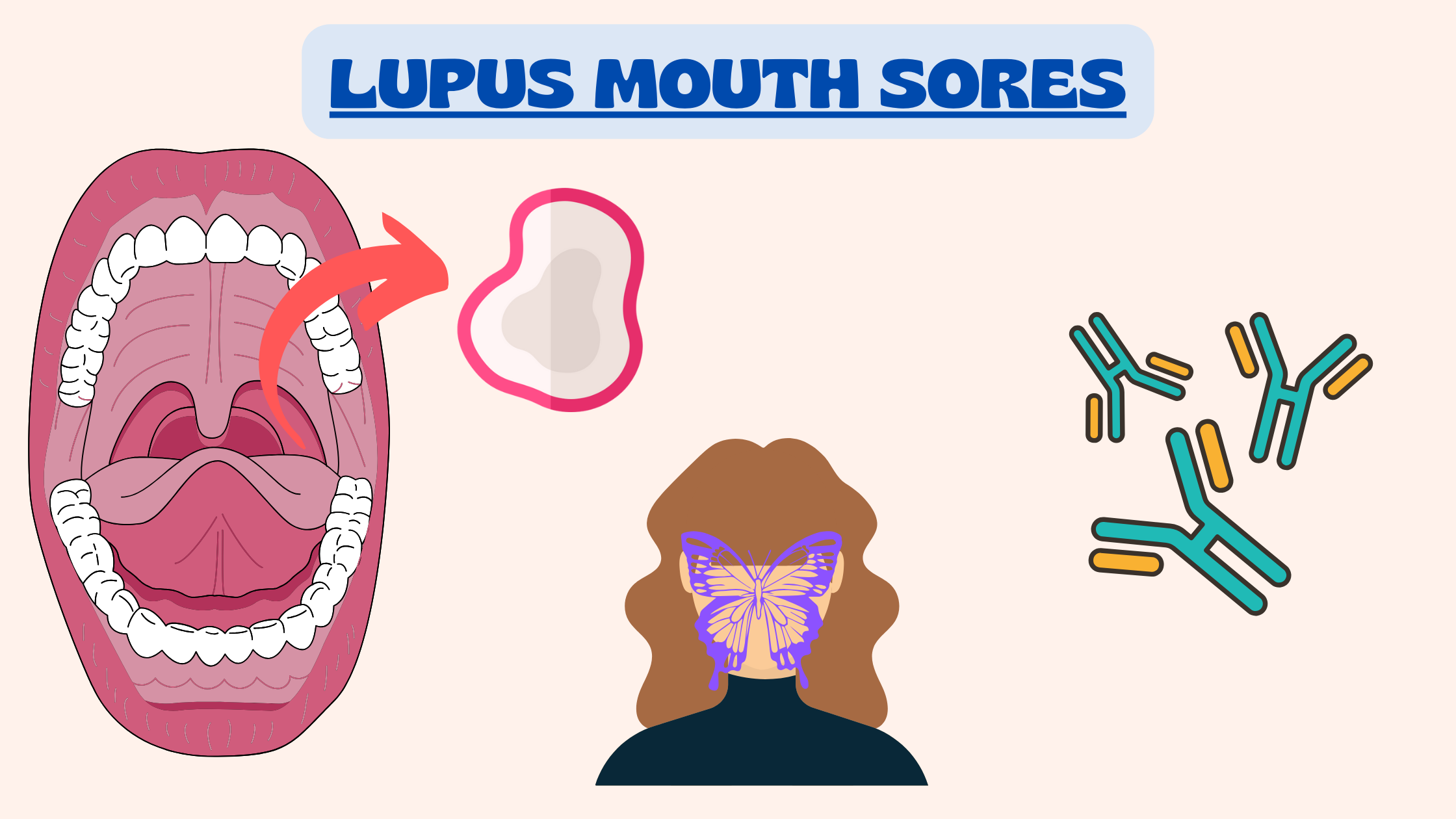 Lupus mouth sores