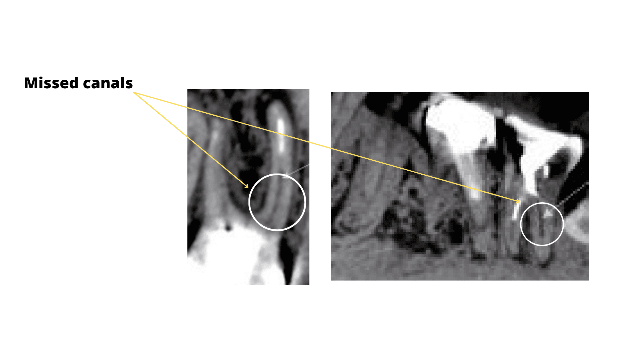 X-rays showing missed root canal
