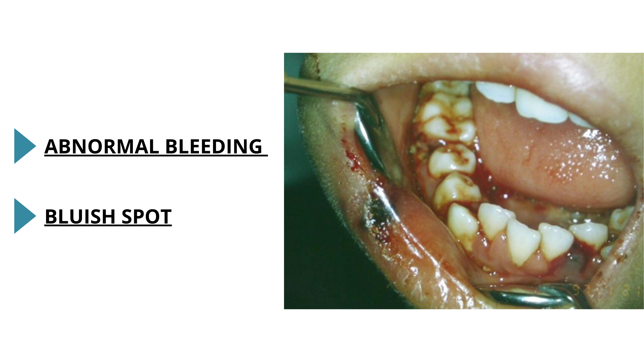mouth bleeding and leukemia