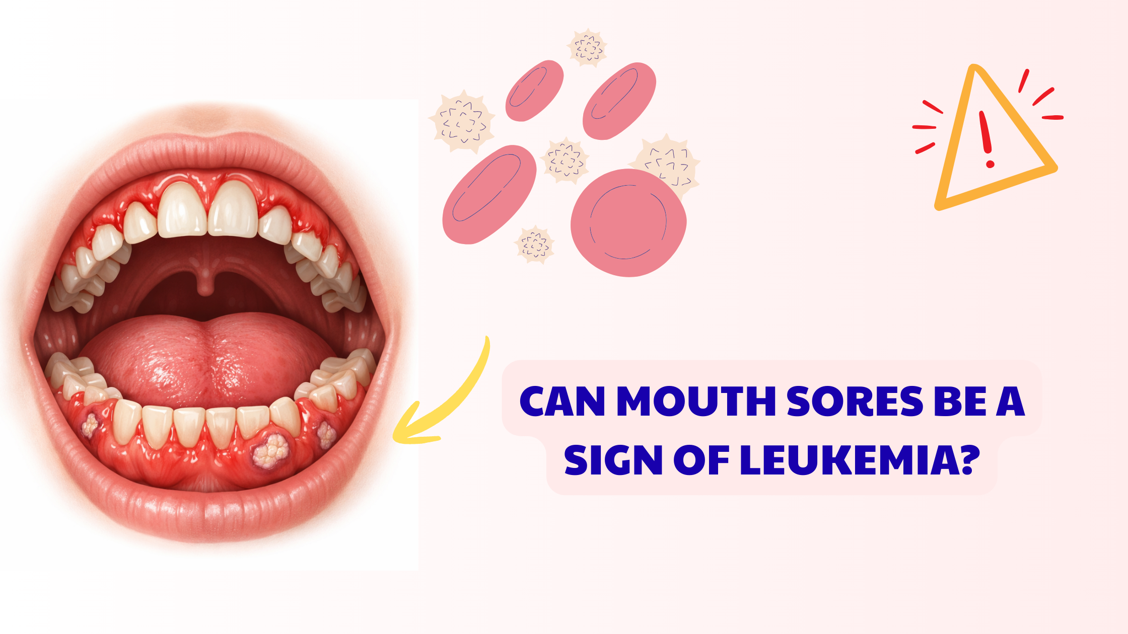 Leukemia mouth sores