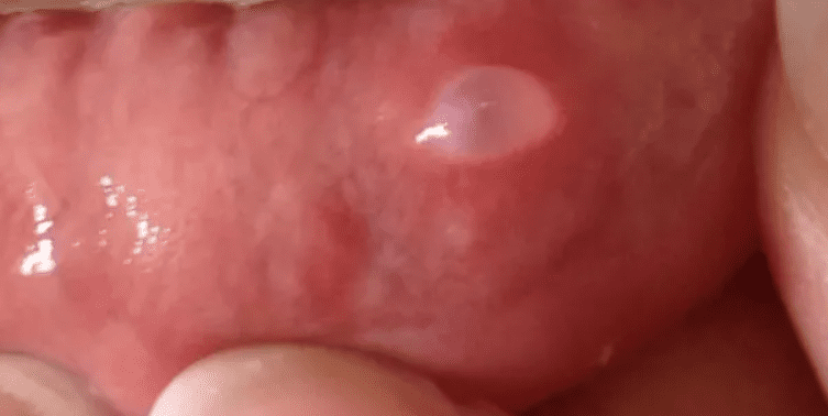 mucocele on the lip