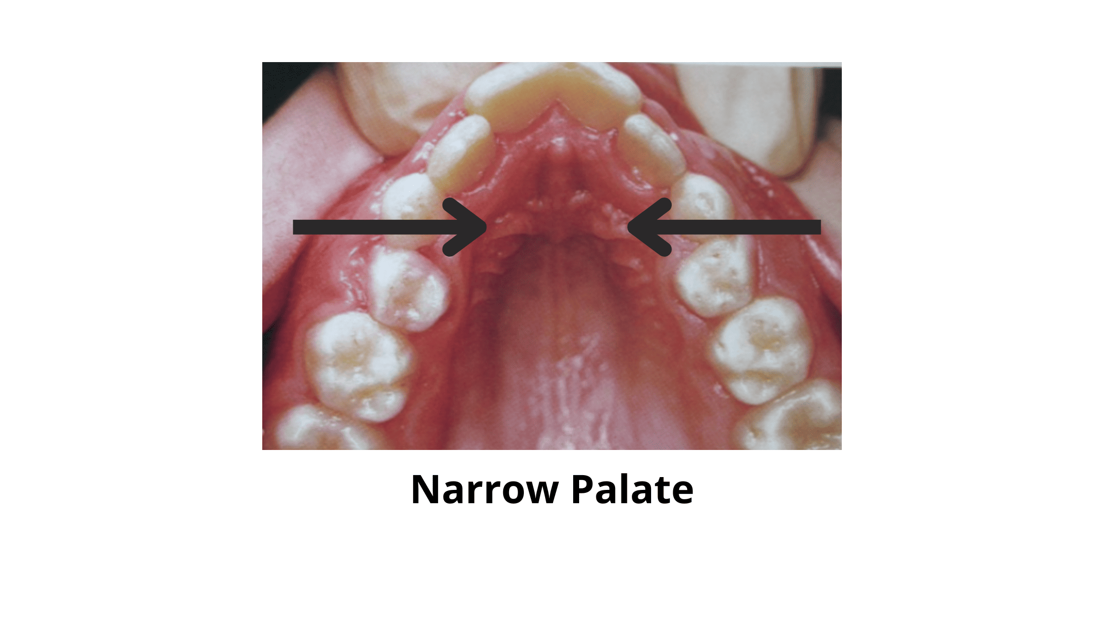 Crossbite Understanding And Treating This Common Issue