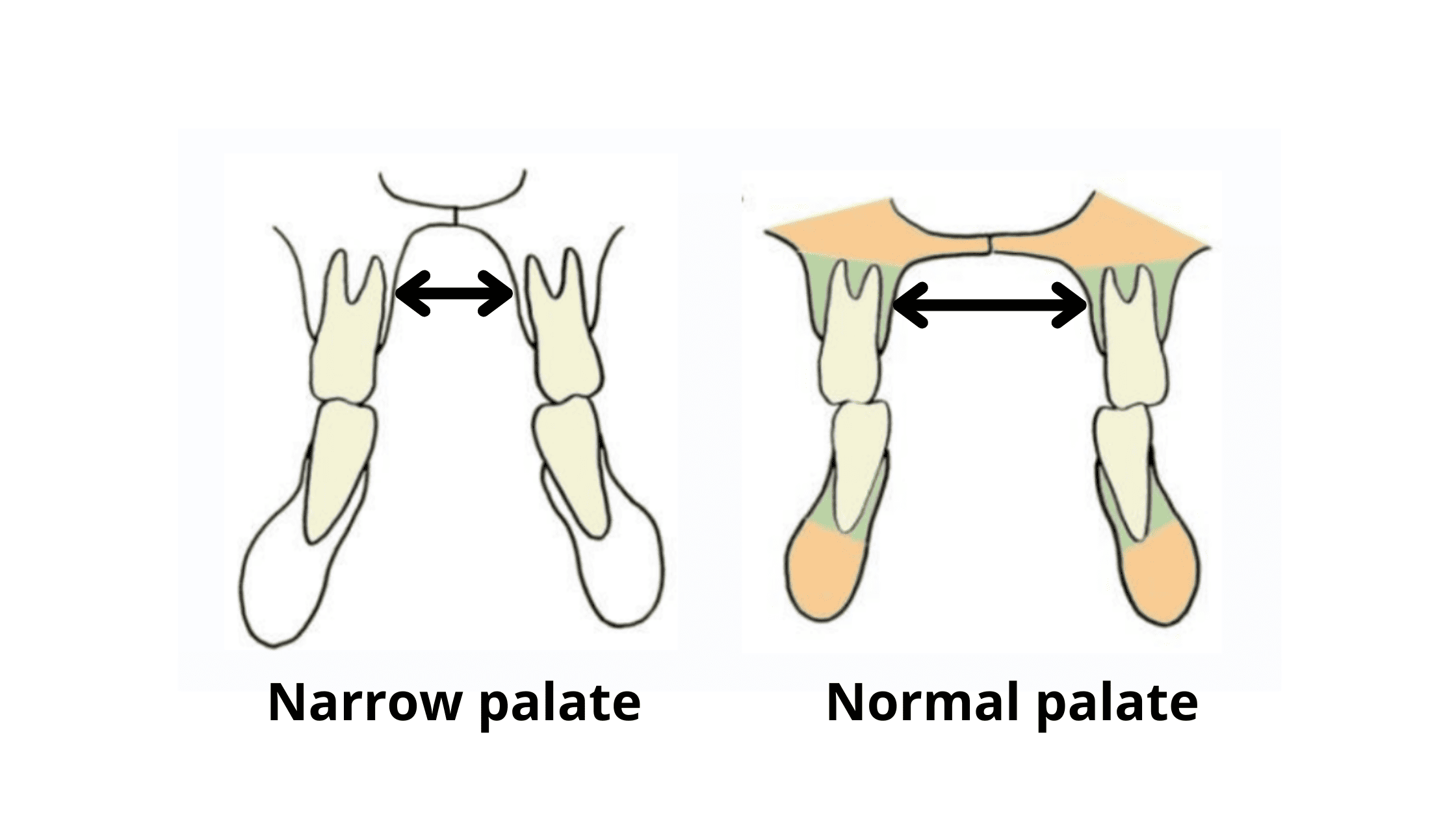 Narrow palate vs. Normal palate