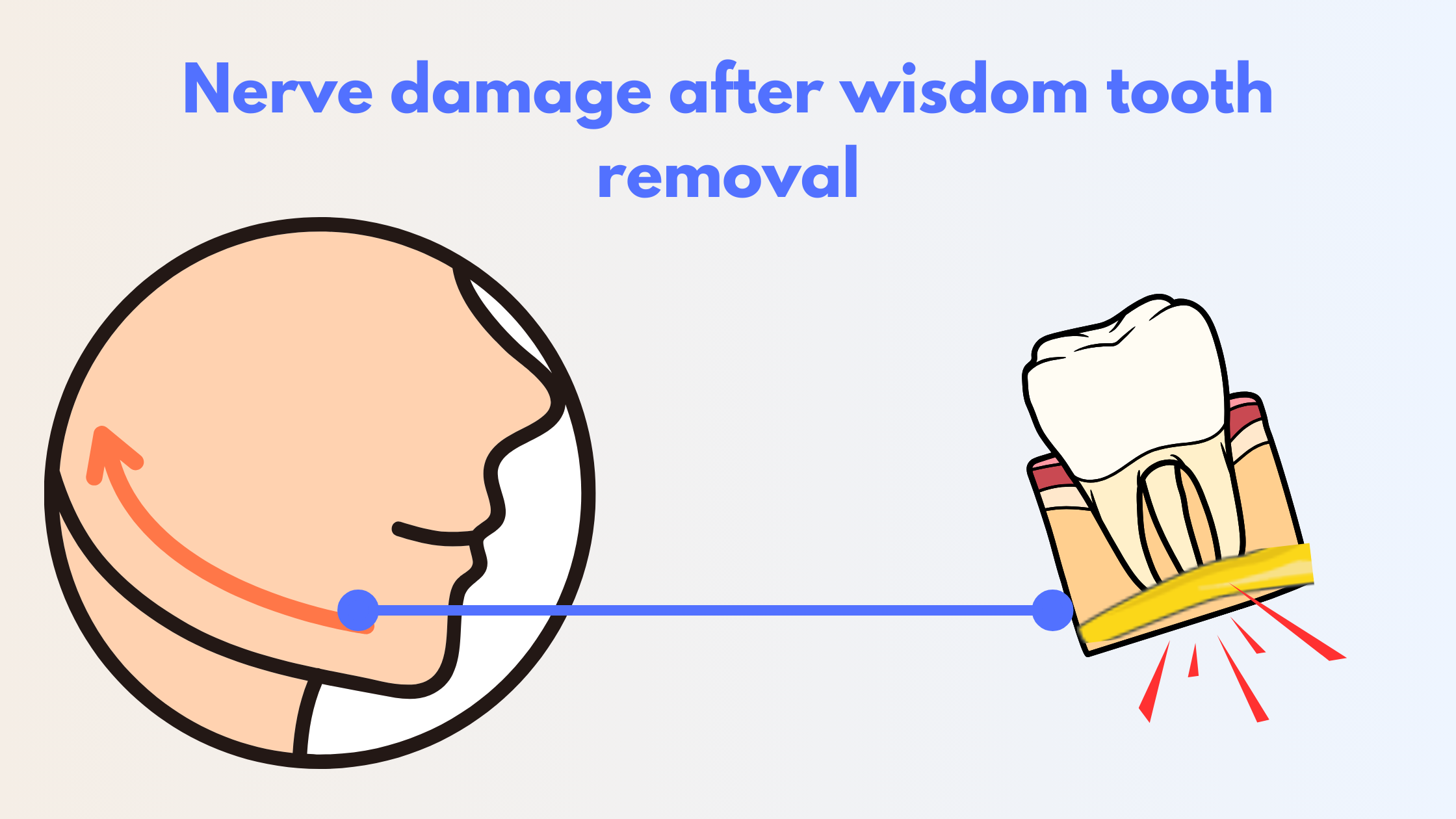 Is Nerve Damage Permanent After Wisdom Teeth Removal Infoupdate