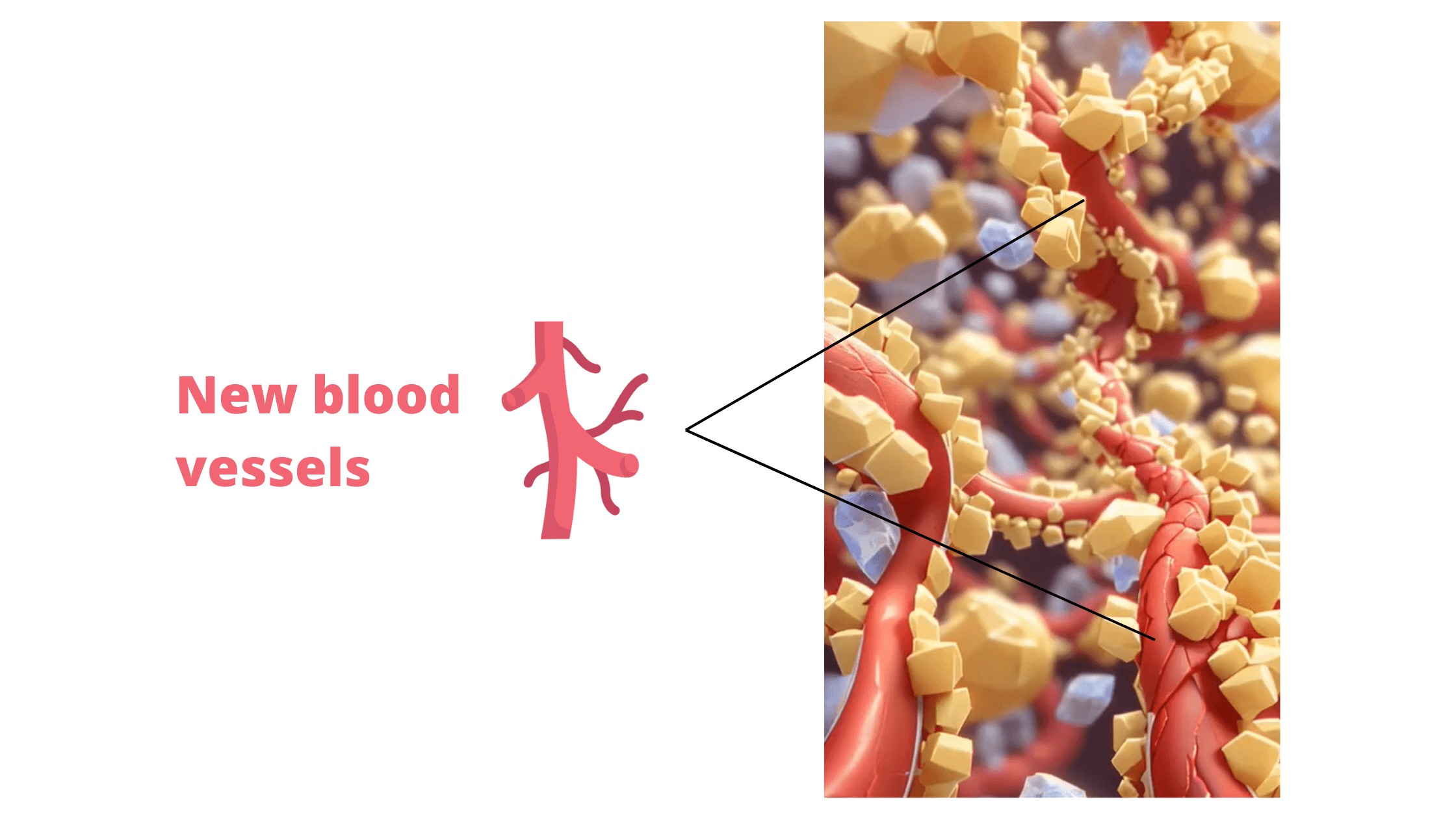 New blood vessels forming inside the bone graft