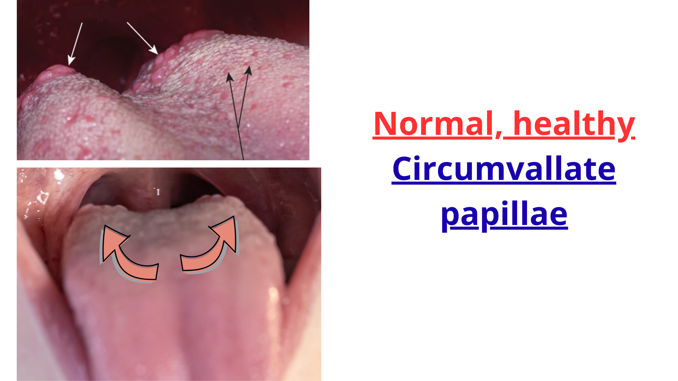 Normal circumvallate papillae showing as multiple bumps on the back of the tongue