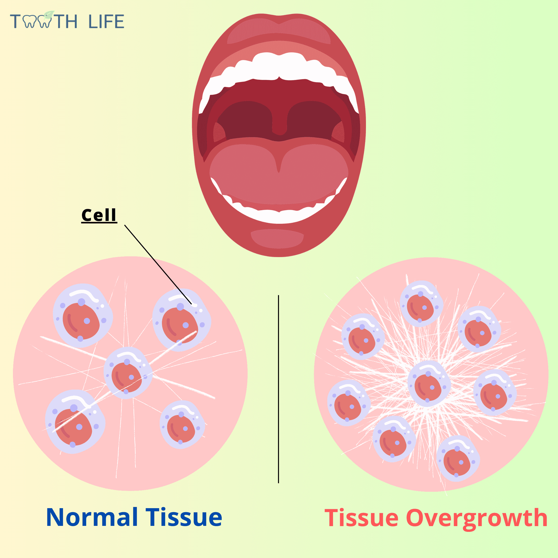 Normal tissue vs fibrous tissue overgrowth